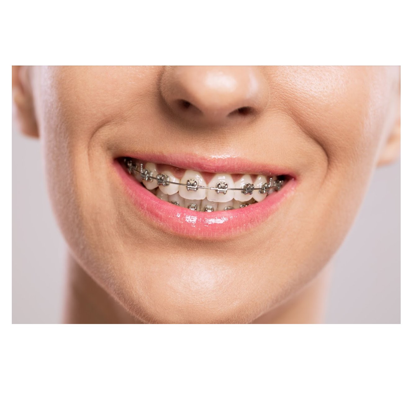 ORTODONCIA RAPIDA GENIOVA: Tratamientos de Clínica Dental Dra. Ana Lucía ORTODONCIA RAPIDA GENIOVA: Tratamientos de Clínica Dental Dra. Ana Lucía