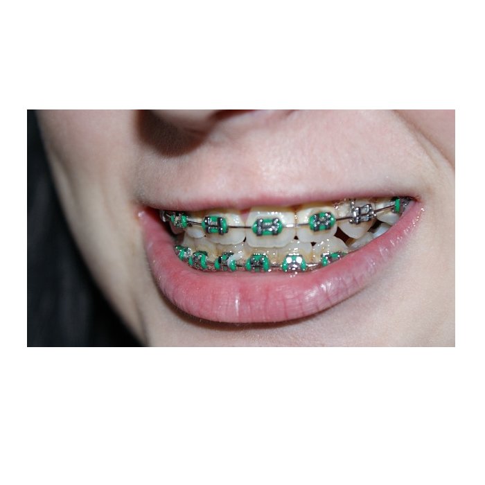Brackets autoligable: Tratamientos de Clínica Dental Dra. Ana Lucía Brackets autoligable: Tratamientos de Clínica Dental Dra. Ana Lucía