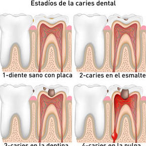 Endodoncia: Servicios de Clínica Dental Reina Victoria 23 }}
