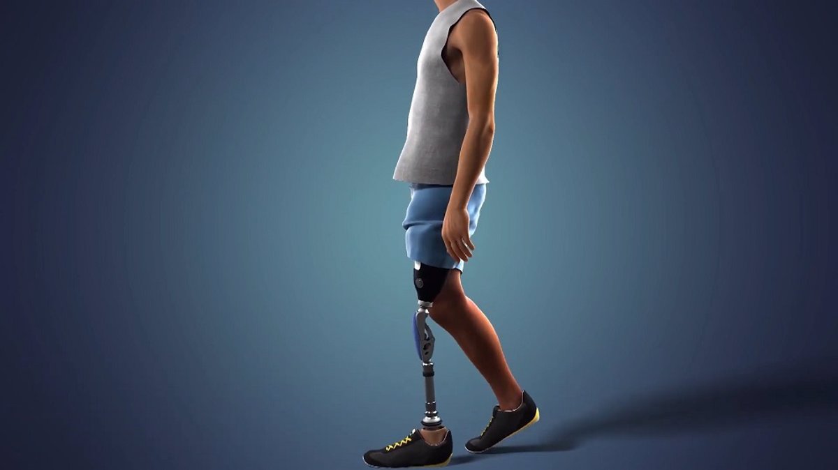 PRIMERA ORTOPEDIA EN ESPAÑA EN IMPLANTAR UN PIE RUSH