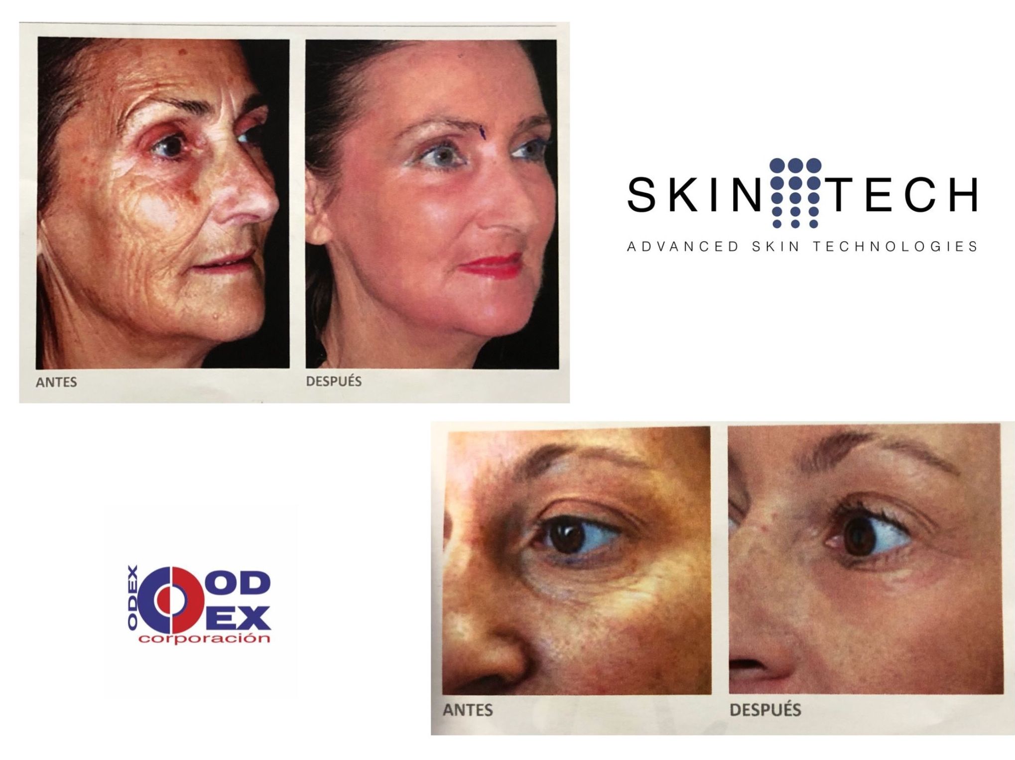 Peeling de Fenol: Tratamientos estéticos de Odex Corporación Peeling de Fenol: Tratamientos estéticos de Odex Corporación