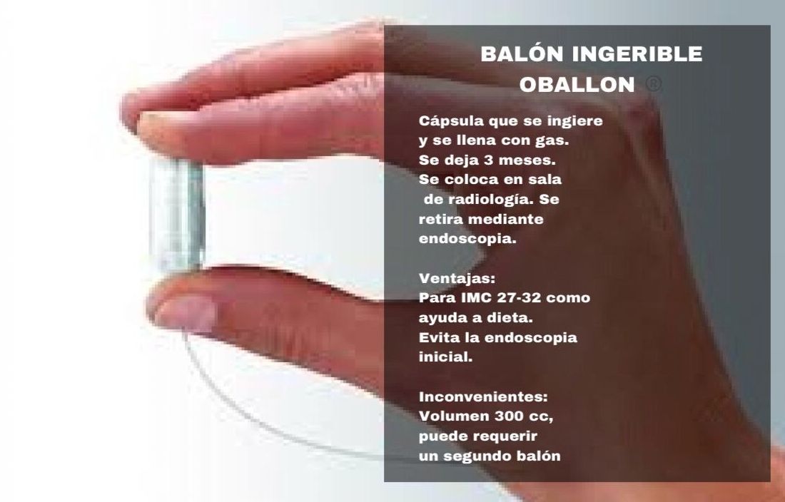 BALÓN INTRAGÁSTRICO: Tratamientos estéticos de Odex Corporación BALÓN INTRAGÁSTRICO: Tratamientos estéticos de Odex Corporación