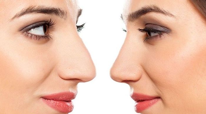 Rinoplastia: Tratamientos estéticos de Odex Corporación Rinoplastia: Tratamientos estéticos de Odex Corporación