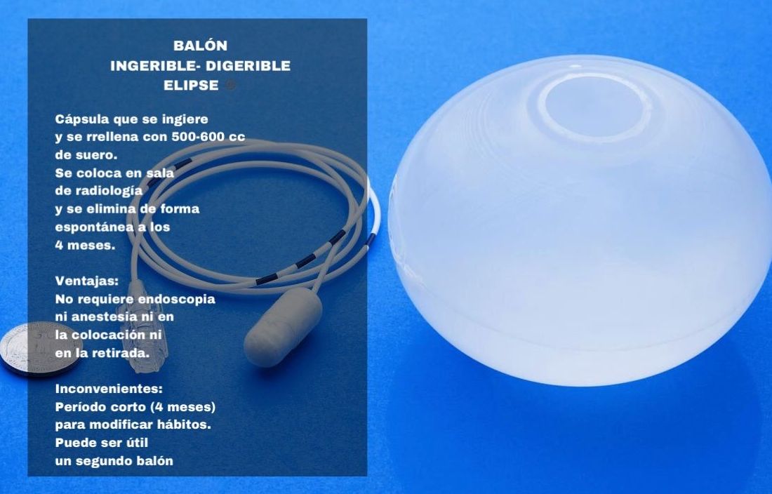 BALÓN INTRAGÁSTRICO: Tratamientos estéticos de Odex Corporación BALÓN INTRAGÁSTRICO: Tratamientos estéticos de Odex Corporación