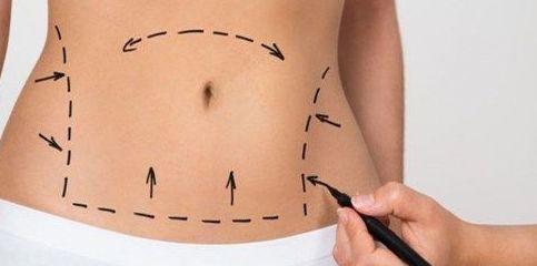 Abdominoplastia: Tratamientos estéticos de Odex Corporación Abdominoplastia: Tratamientos estéticos de Odex Corporación