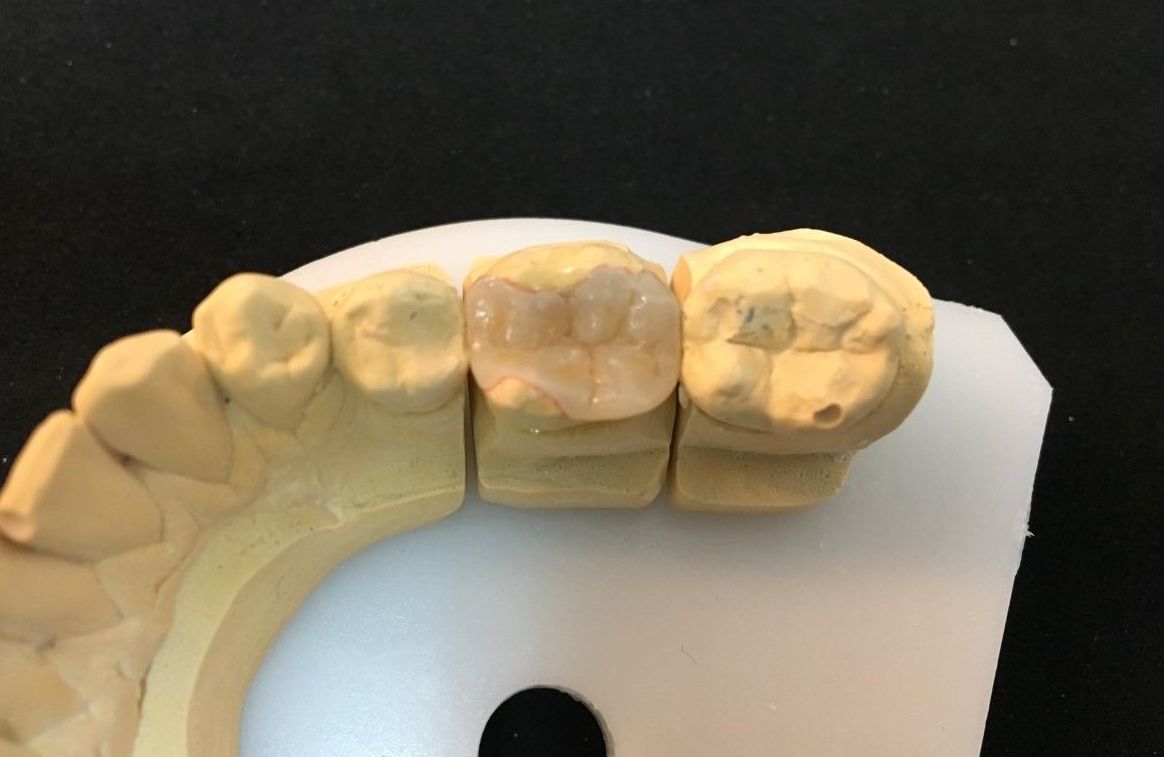INCRUSTACIONES: Servicios de Dentallabor Dirks INCRUSTACIONES: Servicios de Dentallabor Dirks