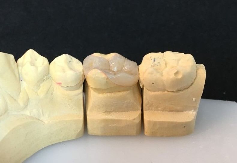 INCRUSTACIONES: Servicios de Dentallabor Dirks INCRUSTACIONES: Servicios de Dentallabor Dirks