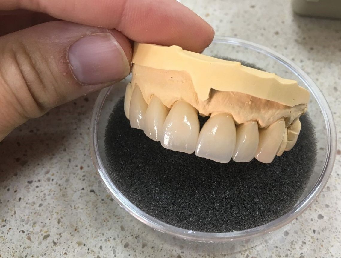 DISILICATO DE LITIO: Servicios de Dentallabor Dirks DISILICATO DE LITIO: Servicios de Dentallabor Dirks