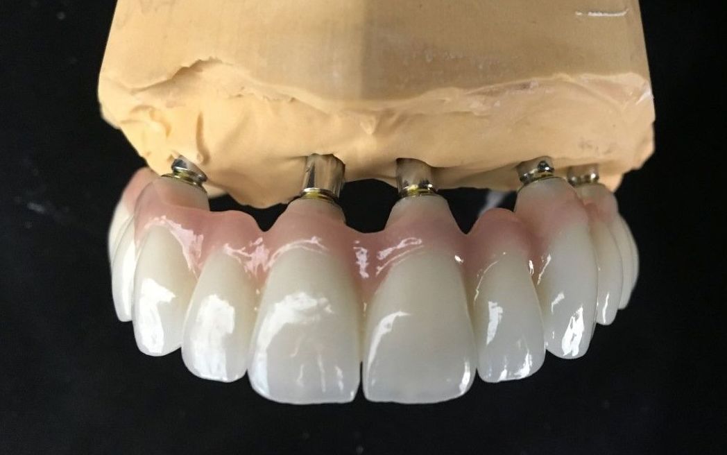 PUENTE DE ZIRCONIO CON INTERFASES DINÁMICOS PUENTE DE ZIRCONIO CON INTERFASES DINÁMICOS