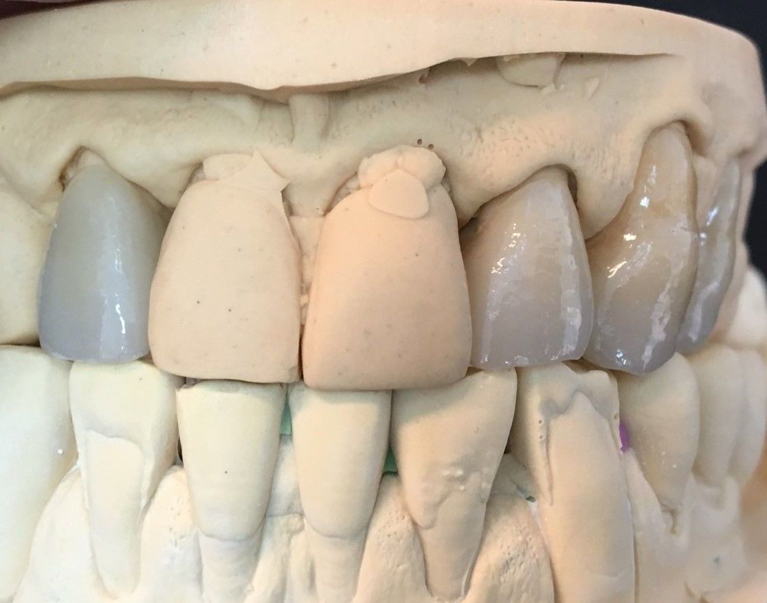 DISILICATO DE LITIO: Servicios de Dentallabor Dirks DISILICATO DE LITIO: Servicios de Dentallabor Dirks