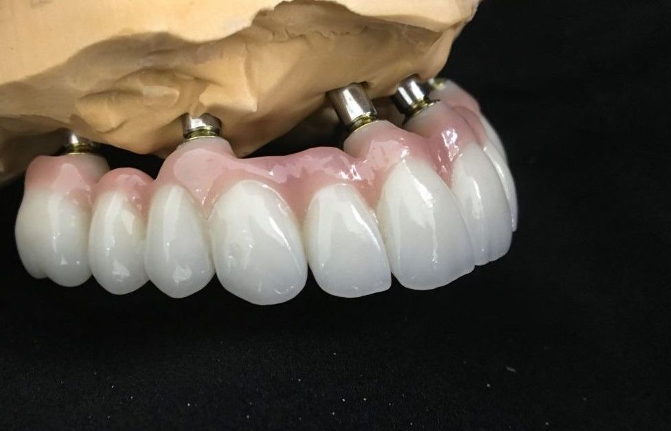 TRABAJOS SOBRE IMPLANTES: Servicios de Dentallabor Dirks TRABAJOS SOBRE IMPLANTES: Servicios de Dentallabor Dirks