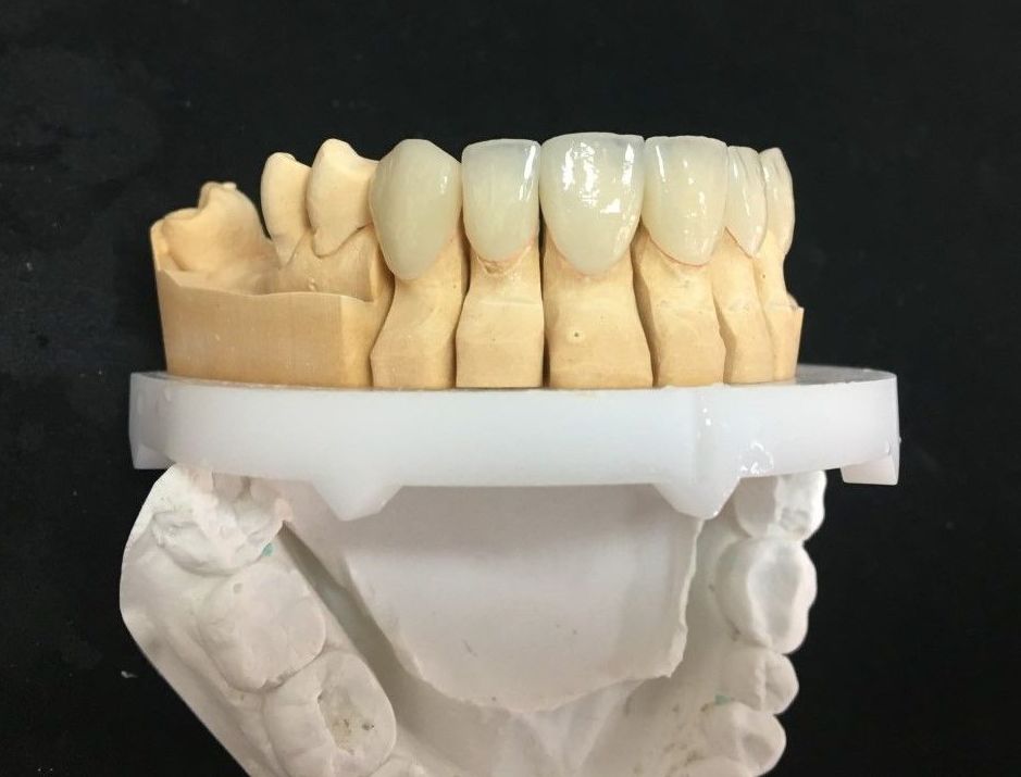 CARILLAS DE DISILICATO DE LITIO Y MICROCARILLAS: Servicios de Dentallabor Dirks CARILLAS DE DISILICATO DE LITIO Y MICROCARILLAS: Servicios de Dentallabor Dirks