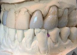 DISILICATO DE LITIO: Servicios de Dentallabor Dirks DISILICATO DE LITIO: Servicios de Dentallabor Dirks