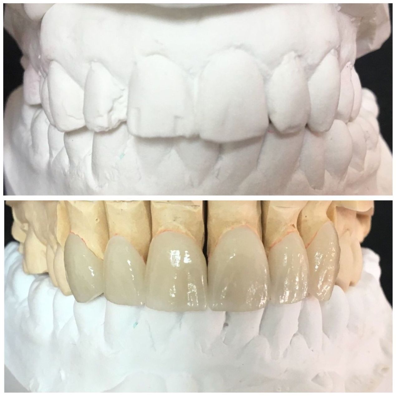 CARILLAS DE DISILICATO DE LITIO Y MICROCARILLAS: Servicios de Dentallabor Dirks CARILLAS DE DISILICATO DE LITIO Y MICROCARILLAS: Servicios de Dentallabor Dirks