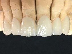 CARILLAS DE DISILICATO DE LITIO Y MICROCARILLAS: Servicios de Dentallabor Dirks CARILLAS DE DISILICATO DE LITIO Y MICROCARILLAS: Servicios de Dentallabor Dirks