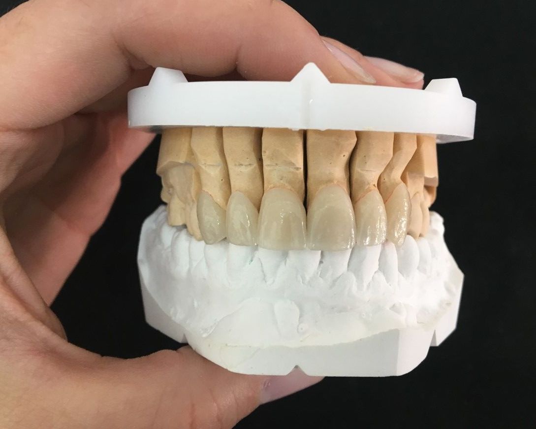 CARILLAS DE DISILICATO DE LITIO Y MICROCARILLAS: Servicios de Dentallabor Dirks CARILLAS DE DISILICATO DE LITIO Y MICROCARILLAS: Servicios de Dentallabor Dirks