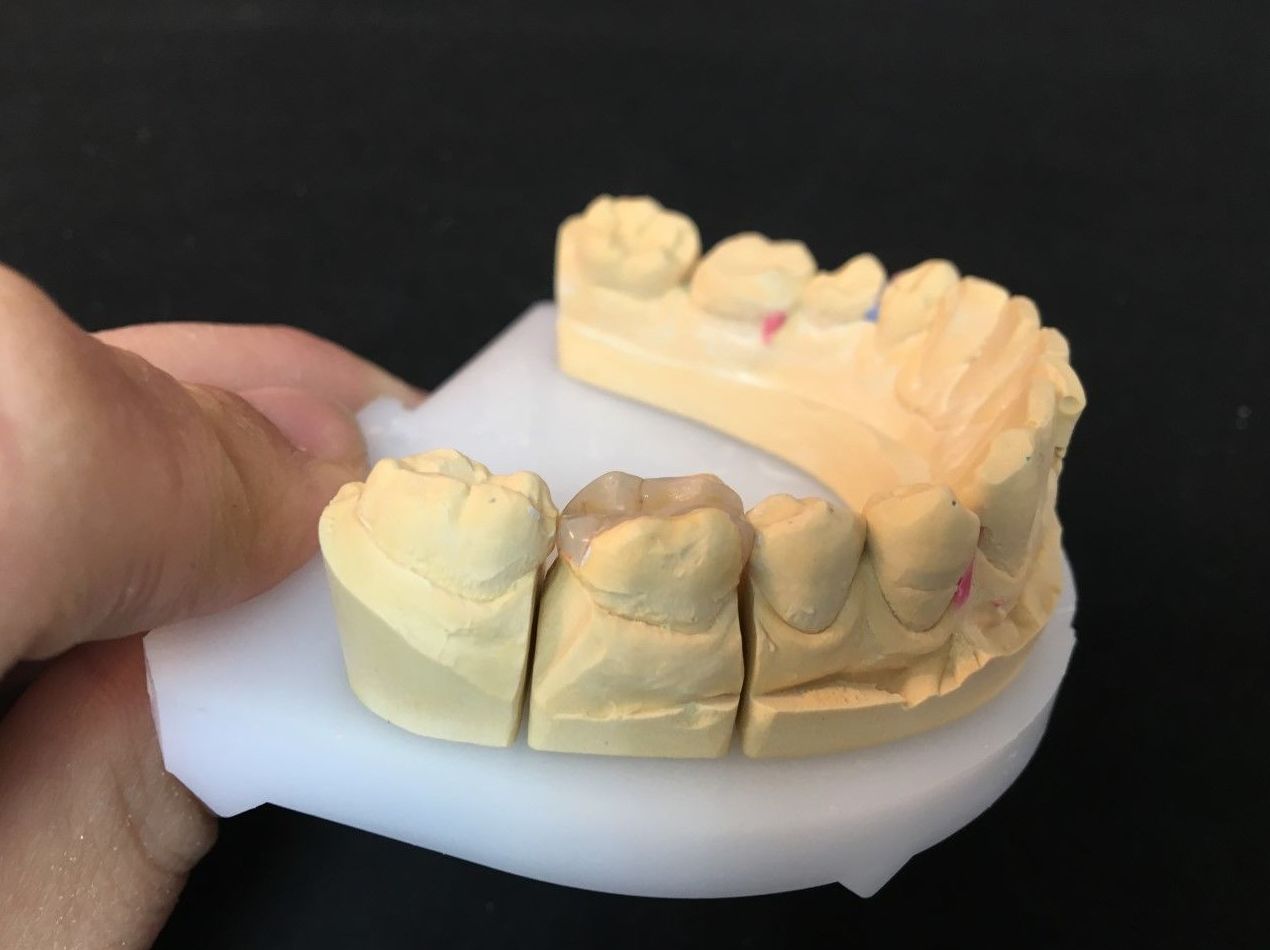 INCRUSTACIONES: Servicios de Dentallabor Dirks INCRUSTACIONES: Servicios de Dentallabor Dirks