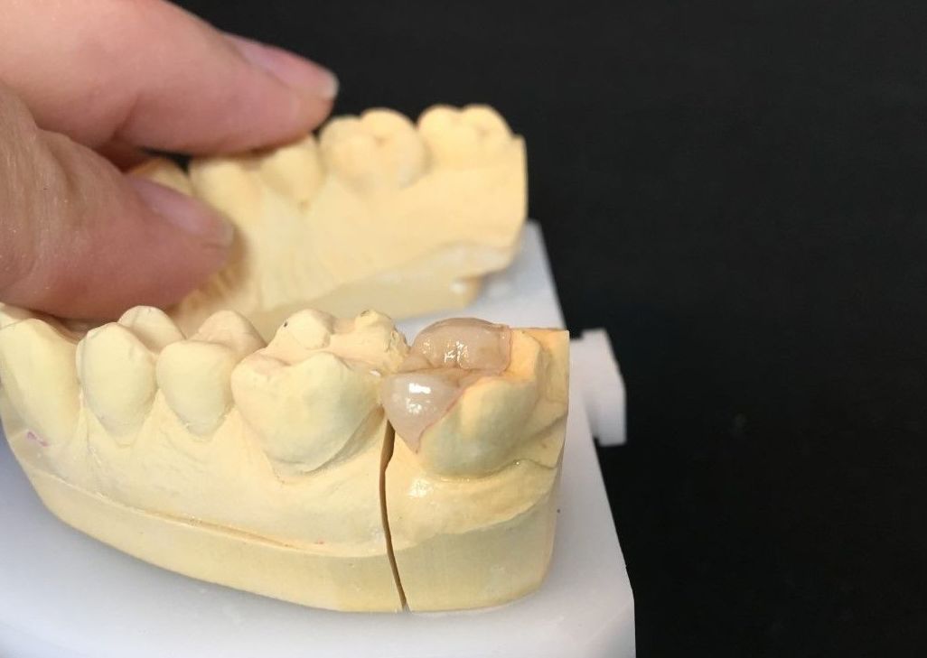 INCRUSTACIONES: Servicios de Dentallabor Dirks INCRUSTACIONES: Servicios de Dentallabor Dirks