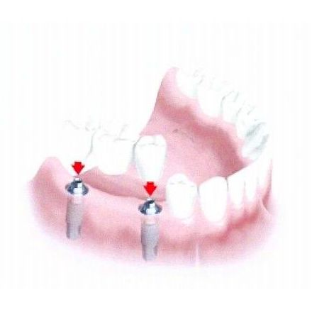 Implantes: Tratamientos de Clínica Dental Humanes 61 }}