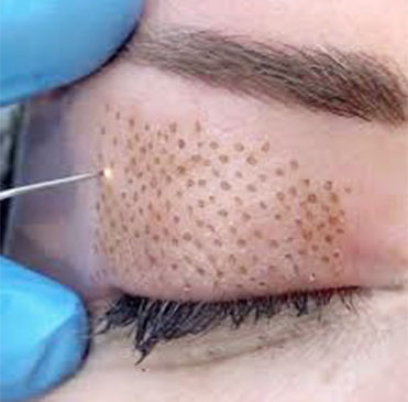 Tratamiento para los Párpados: Tratamientos de Dr. Felipe Bárcenas Tratamiento para los Párpados: Tratamientos de Dr. Felipe Bárcenas