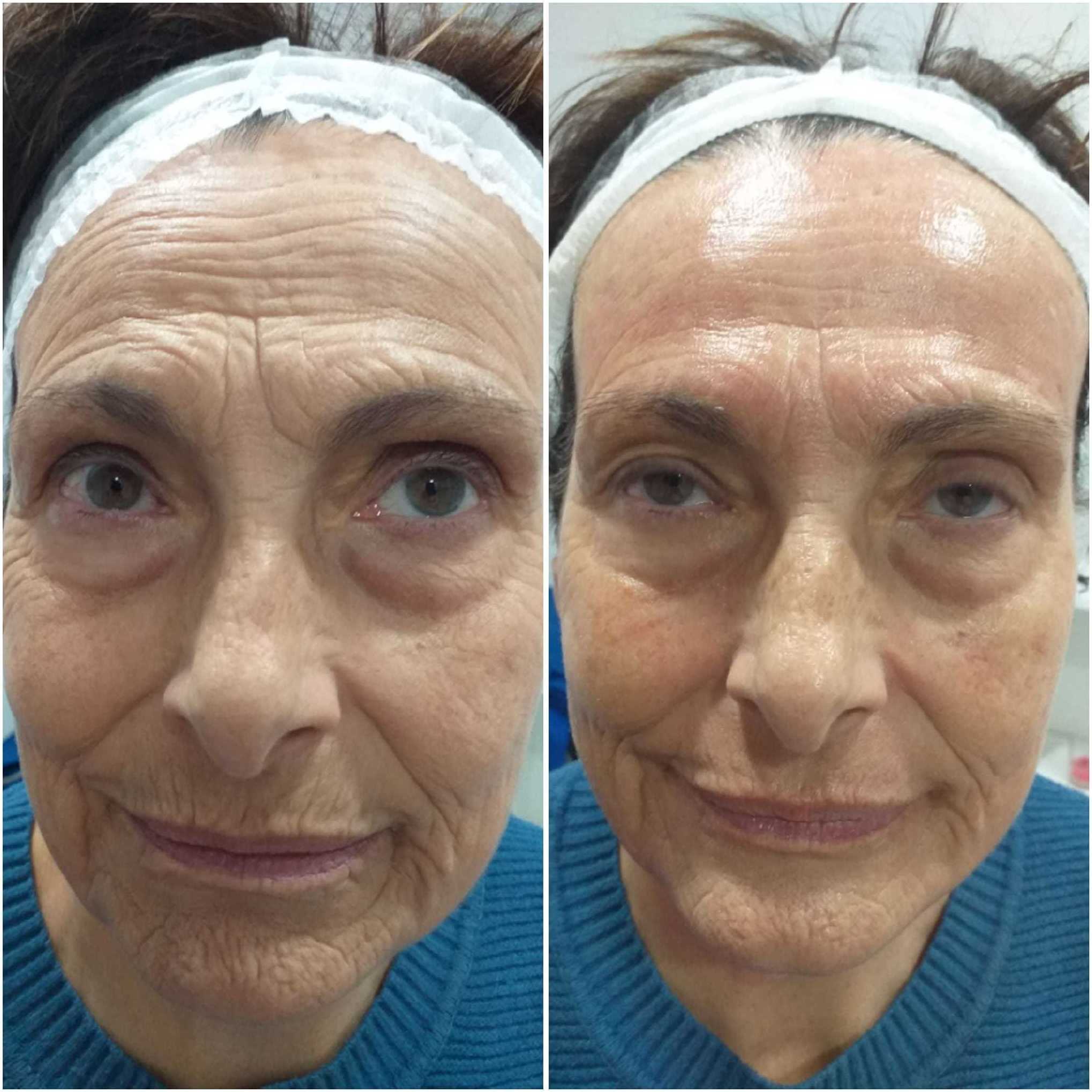 Super Lifting Program: Tratamientos estéticos de Centro de Belleza Venus Super Lifting Program: Tratamientos estéticos de Centro de Belleza Venus