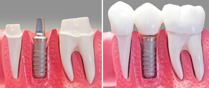 Implantología bucal: Tratamientos de Clínica Dents Implantología bucal: Tratamientos de Clínica Dents