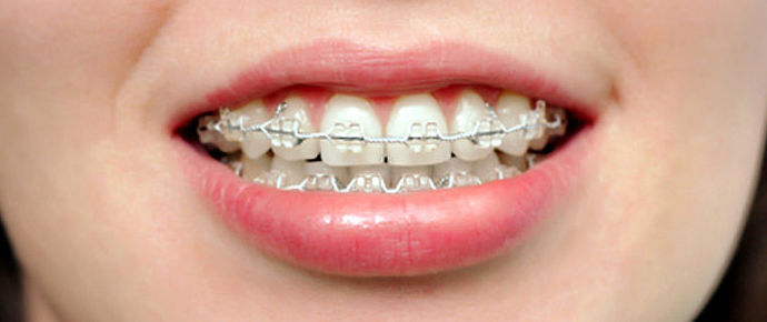 Ortodoncia: Tratamientos de Clínica Dents Ortodoncia: Tratamientos de Clínica Dents