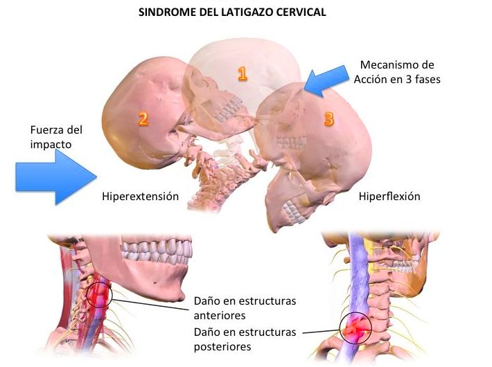 sindrome de latigazo cervical