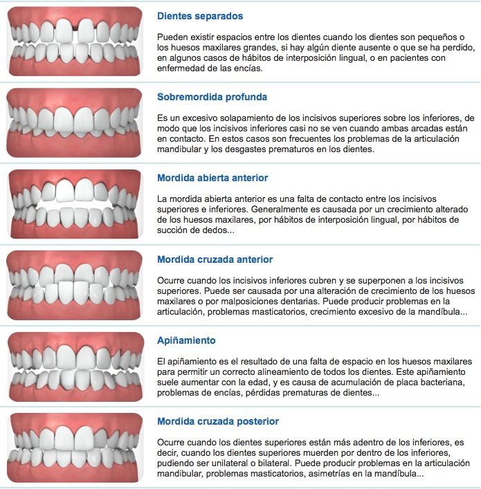 Para que se utiliza la ortodoncia Inivisalign en Sarrià - Sant Gervasi