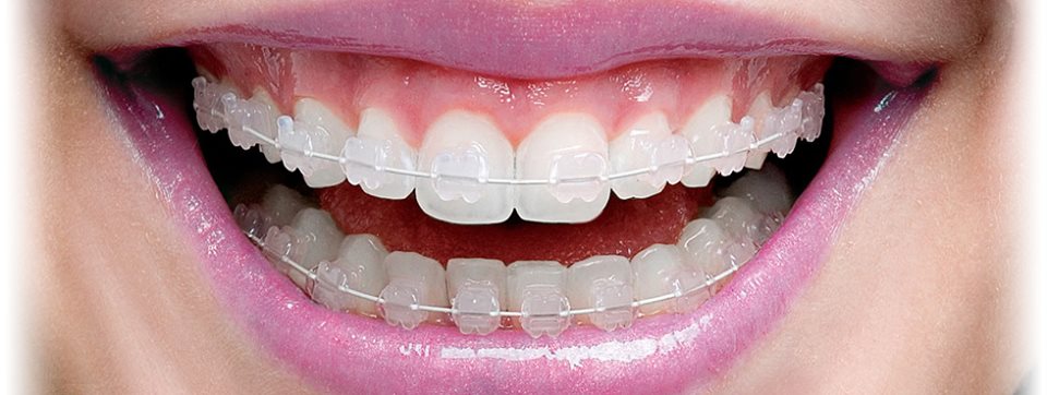 Ortodoncia: Tratamientos de Dental Valls Ortodoncia: Tratamientos de Dental Valls