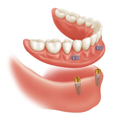 Prótesis dental: Tratamientos de Dental Valls Prótesis dental: Tratamientos de Dental Valls