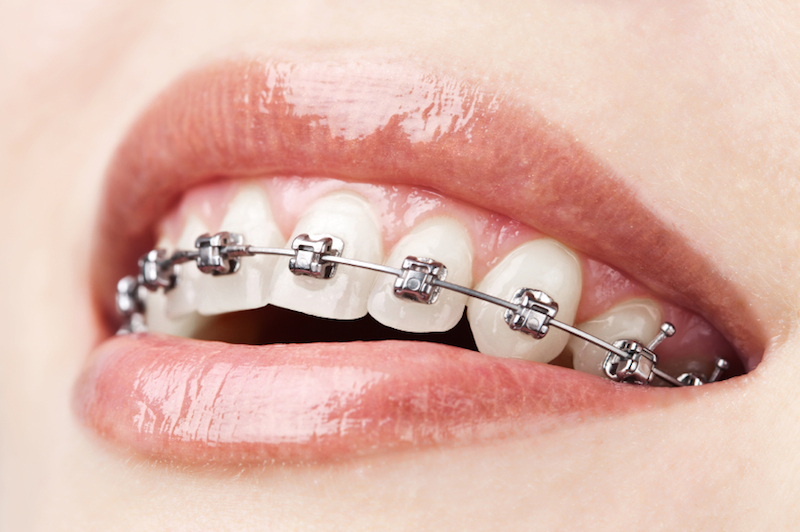 Ortodoncia: Tratamientos de Dental Valls Ortodoncia: Tratamientos de Dental Valls