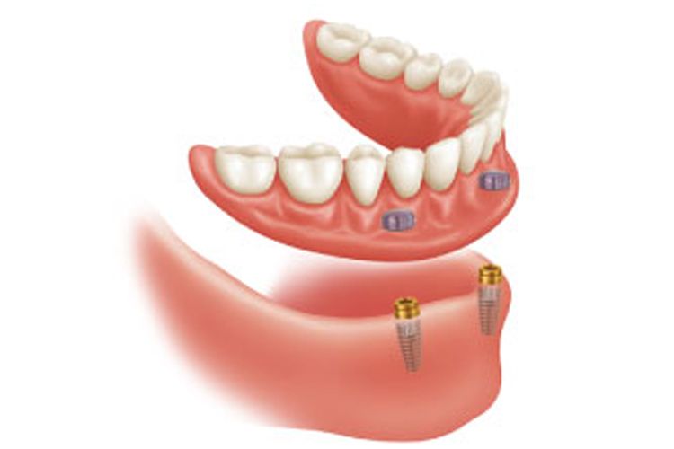 Implantes dentales en Valls