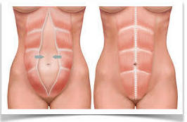 Diástasis de rectos: Patologías y Tratamientos de Dra. Gutiérrez Moreno Diástasis de rectos: Patologías y Tratamientos de Dra. Gutiérrez Moreno