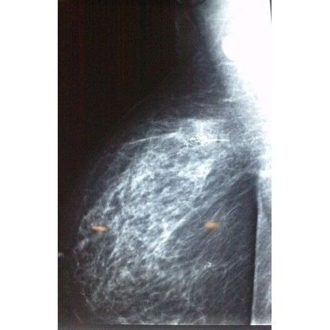 Cancer de mama: Patologías y Tratamientos de Dra. Gutiérrez Moreno Cancer de mama: Patologías y Tratamientos de Dra. Gutiérrez Moreno