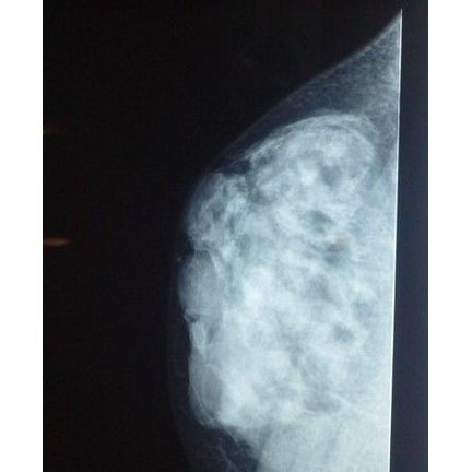 Mastopatía fibroquística: Patologías y Tratamientos de Dra. Gutiérrez Moreno Mastopatía fibroquística: Patologías y Tratamientos de Dra. Gutiérrez Moreno