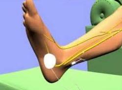 Neuromodulacion periférica ( tibial posterior ): Patologías y Tratamientos de Dra. Gutiérrez Moreno Neuromodulacion periférica ( tibial posterior ): Patologías y Tratamientos de Dra. Gutiérrez Moreno