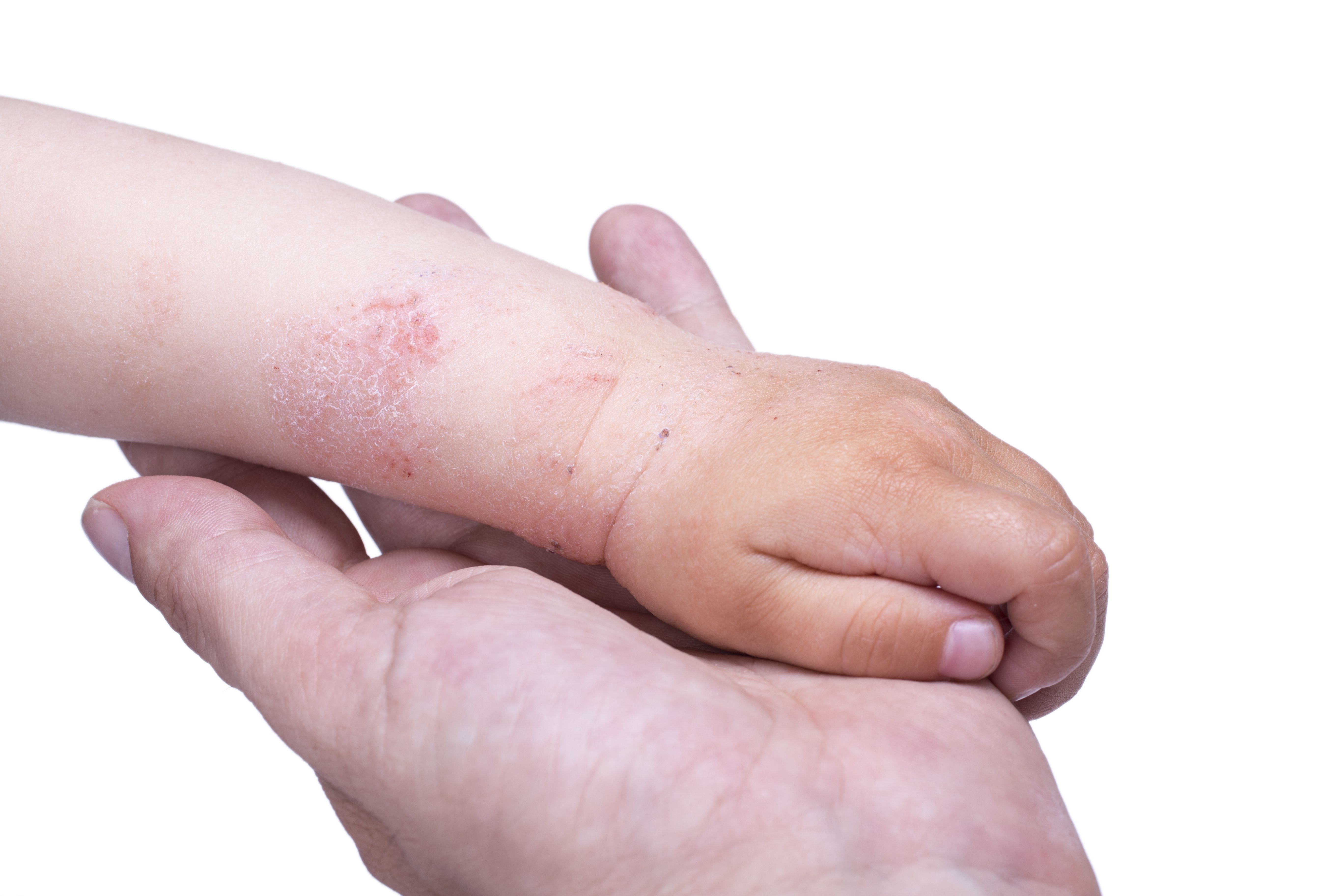Dermatitis: Servicios de Pujol Montcusí. Dr. Dermatitis: Servicios de Pujol Montcusí. Dr.
