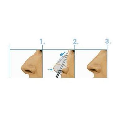 Rinoplastia: Técnicas de Clínica de Otorrinolaringología Rinoplastia: Técnicas de Clínica de Otorrinolaringología