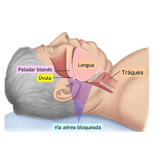Ronquido: Técnicas de Clínica de Otorrinolaringología Ronquido: Técnicas de Clínica de Otorrinolaringología