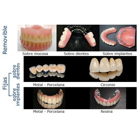 Prótesis dentales: Servicios de Alser Dental Prótesis dentales: Servicios de Alser Dental