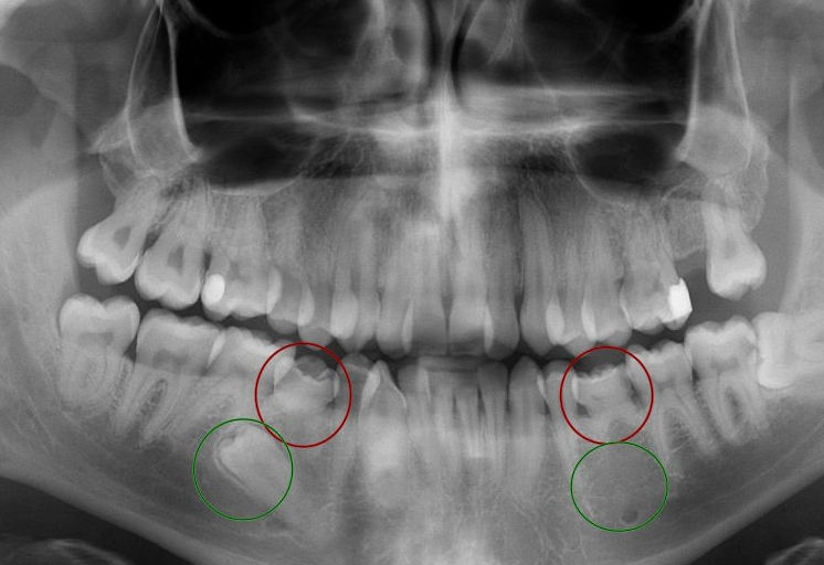 RX Agnesia verde derecho RX Agnesia verde derecho