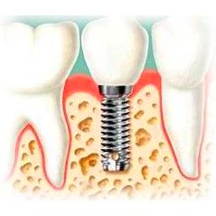 Cirugía dental: Servicios de Alser Dental Cirugía dental: Servicios de Alser Dental