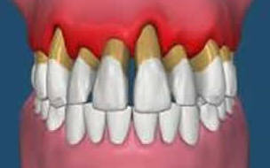 Destrucción del periodonto. Destrucción del periodonto.
