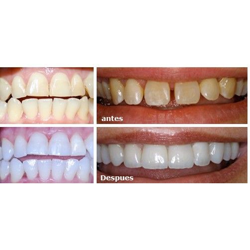 Estética Dental: Servicios de Alser Dental Estética Dental: Servicios de Alser Dental