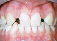 Agenesia dental Agenesia dental