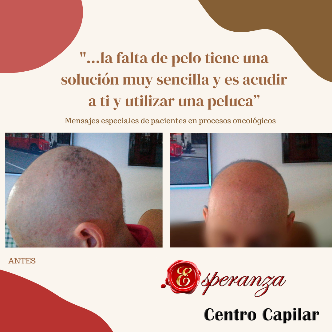 Implantes y Pelucas: Servicios de Esperanza Centro Capilar Implantes y Pelucas: Servicios de Esperanza Centro Capilar