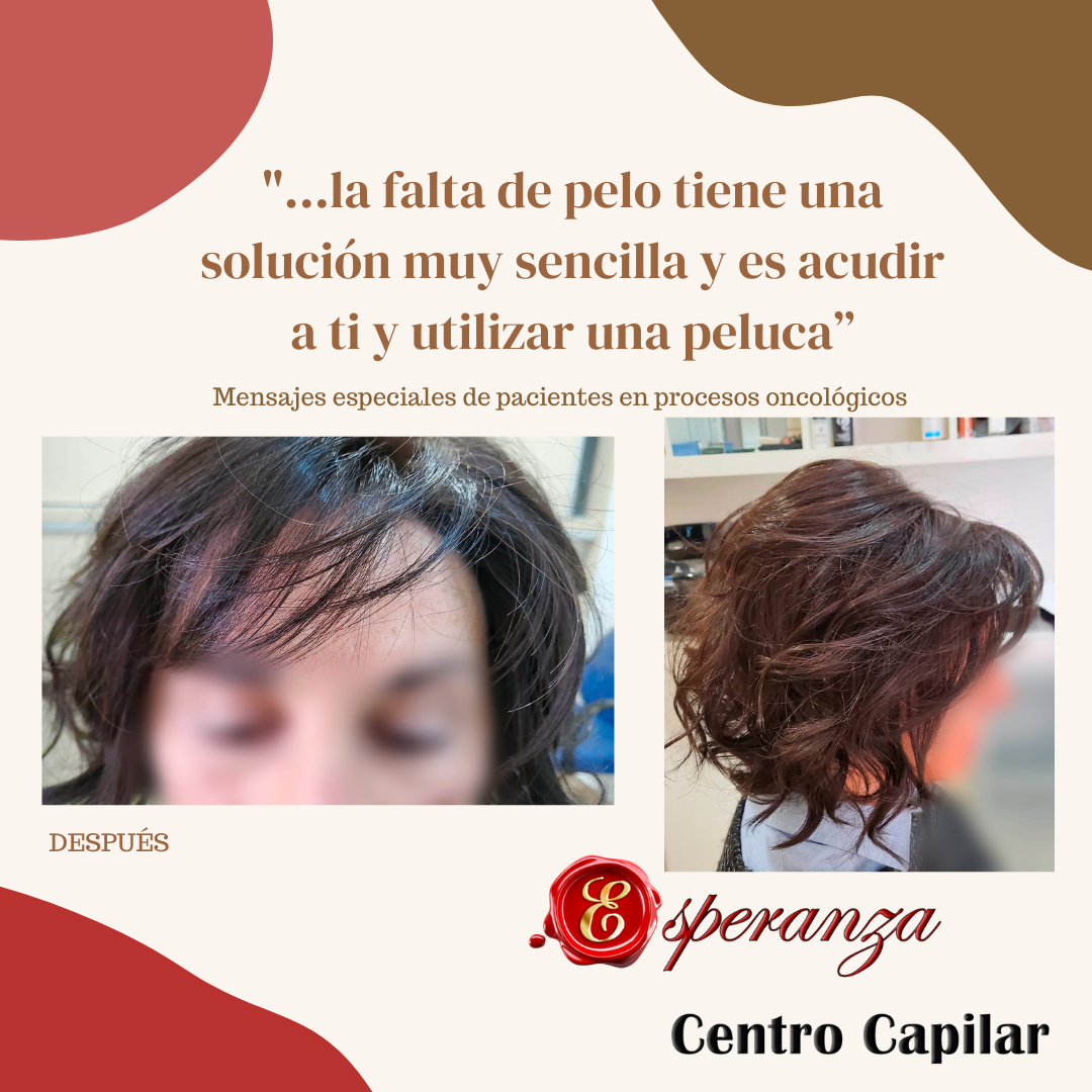 Implantes y Pelucas: Servicios de Esperanza Centro Capilar Implantes y Pelucas: Servicios de Esperanza Centro Capilar