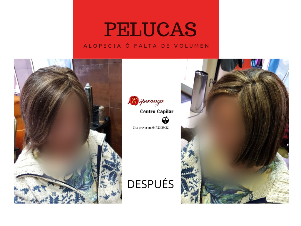 Implantes y Pelucas: Servicios de Esperanza Centro Capilar Implantes y Pelucas: Servicios de Esperanza Centro Capilar