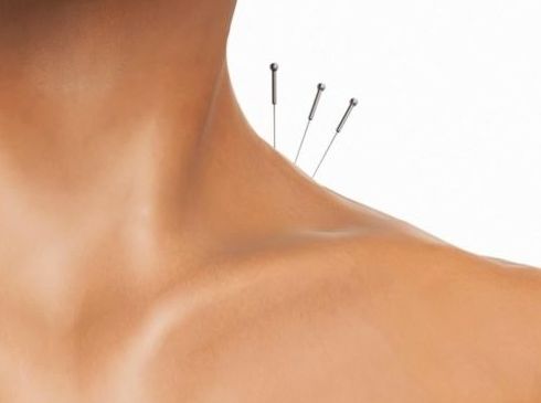 ACUPUNTURA: Tratamientos de Centro de belleza y medicina estética Lucy Lara ACUPUNTURA: Tratamientos de Centro de belleza y medicina estética Lucy Lara